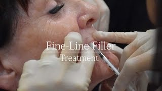 Cheek Filler Technique with Cannula I Breakdown [upl. by Olsewski870]