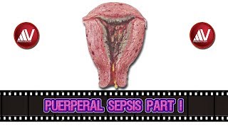 Puerperal Sepsis Part I [upl. by Selrahc]