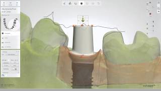 Customized abutment and a crown design [upl. by Ayatal798]