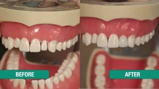 Uveneer Peg Lateral and Diastema Closure [upl. by Roanne]