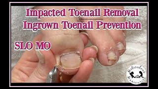 How to Clean Impacted Toenails to Prevent Ingrown Toenails [upl. by Eedyak]