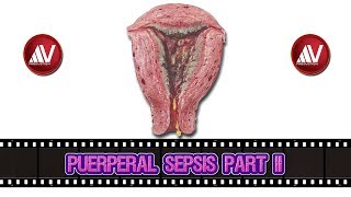 Puerperal Sepsis Part II [upl. by Aniale]