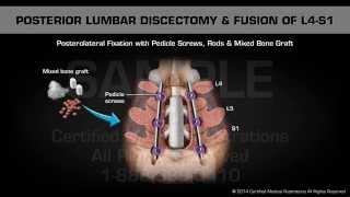 Posterior Lumbar Discectomy amp Fusion of L4S1 [upl. by Iveson]