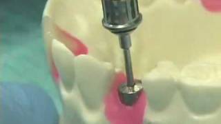 Placing Implant Abutments [upl. by Dihgirb]