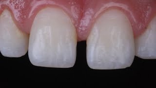 diastema closure with composite resin [upl. by Sida]