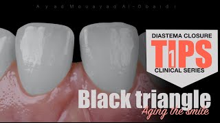 Black triangle diastema closure clinical tips series [upl. by Hazaki]