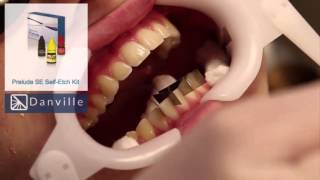 Direct Composite Veneers A NonInvasive Procedure  Dr Brian Mills [upl. by Otreblig]