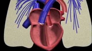 PFO closure animation [upl. by Fidellas641]