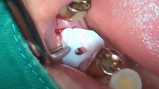 Customized healing abutment [upl. by Raffaj720]