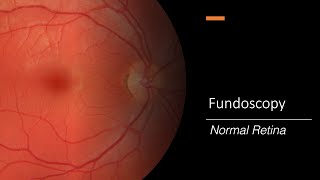 Healthy Retina Fundoscopy [upl. by Kathleen549]