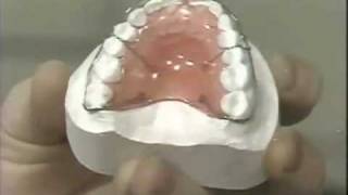 Diastema Closure  Hawley Retainer [upl. by Atte]