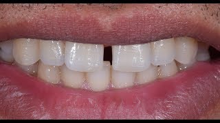 Diastema closure using Bioclear method [upl. by Ennovahs]