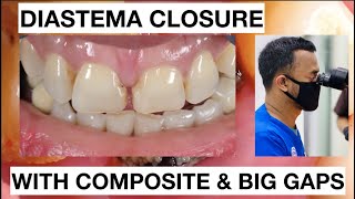 Step by Step Diastema Closure Composite with Big Gaps  General Dentist Griya RR [upl. by Tiat806]