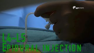 L4L5 epidural injection [upl. by Hsirahc]