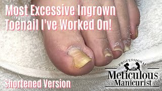 Most Extreme Ingrown Toenail Salon Pedicure  Shortened [upl. by Auria787]