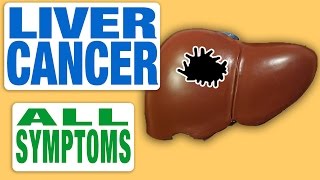 Liver Cancer  All Symptoms [upl. by Wiebmer]