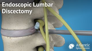 Endoscopic Lumbar Discectomy [upl. by Faye]