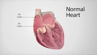 Normal Heart vs Heart in AFib [upl. by Tterab]