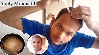 How To Apply Minoxidil 5। Proper Use Of Minoxidil For Hair Regrowth । Sonu Kumar Mishra। [upl. by Horick]