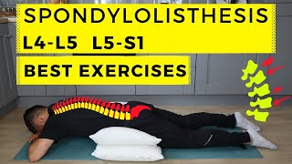 Spondylolisthesis treatment [upl. by Tippets]