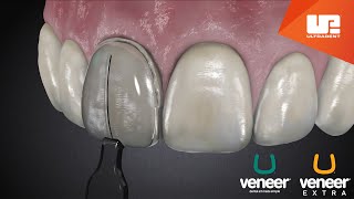 Uveneer® Procedure Animation  Direct Veneer Template System [upl. by Arri]