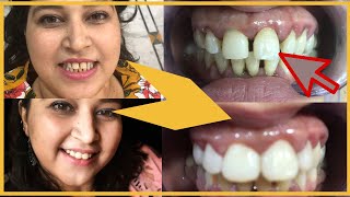 How to close the Gaps in Teeth COMPOSITE FILLING Midline Diastema  my teeth procedure 1 [upl. by Charry]