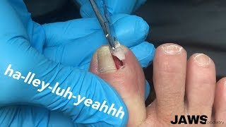 REMOVING A LARGE INGROWN TOENAIL [upl. by Magill]