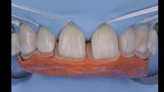 Multiple Diastema closure and ReCentering a Midline Deviation [upl. by Peirsen]