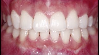 Case of the Week Camouflaging Diastemata with Composite Bonding [upl. by Kistner]