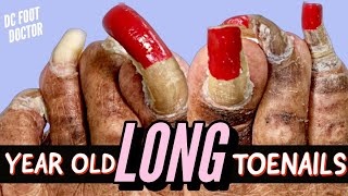 Year Old Long Toenails Trimming Extremely Long Toenails [upl. by Randi]