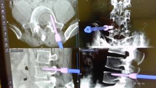 Right L45 Endoscopic TLIF [upl. by Ahsinauq]