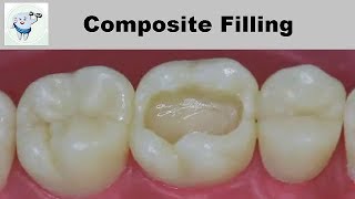 Composite Dental Filling Step by Step [upl. by Tiler]