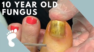 Fungus Takes Over Toenail  Toenail Removal [upl. by Gabriel]