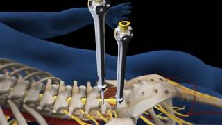 Lumbar Fusion of L5 S1 Animation [upl. by Tuneberg]