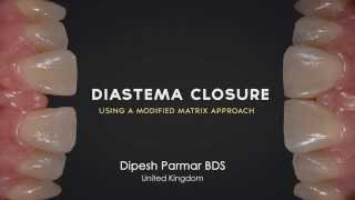 Diastema Closure Perfection  Using a modified matrix approach [upl. by Otsuaf]