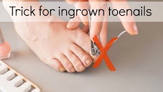 How to Fix Ingrown Toenails Easily [upl. by Austina]