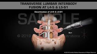 Transverse Lumbar Interbody Fusion at L45 amp L5S1  Medical Animation [upl. by Osnola739]