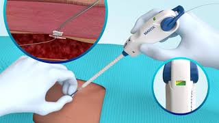 MANTA® Vascular Closure Device Deployment [upl. by Oidacra]