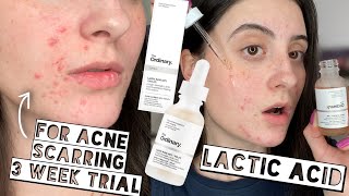 TESTING THE ORDINARY LACTIC ACID 10  HA ON ACNE SCARS FOR 3 WEEKS  Sensitive  Dry Skin [upl. by Neeloc104]