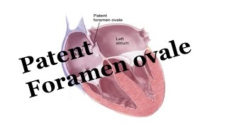 Atrial Septal Defect ASD Animation [upl. by Slack753]